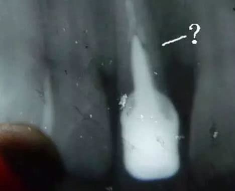 个人拔牙要当心3个并发症,拔牙8颗有什么影响