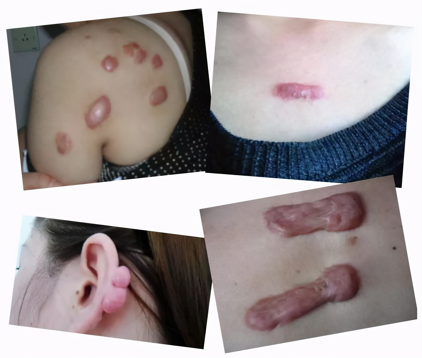 无缘无故身上长了好多疤痕疙瘩,疤痕体质身上到处疙瘩