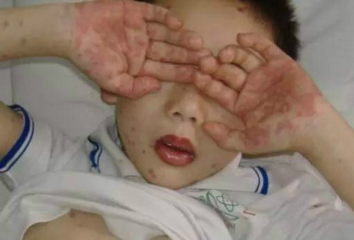 最近中招手足口病的宝宝,手足口病夏季高发几岁常见