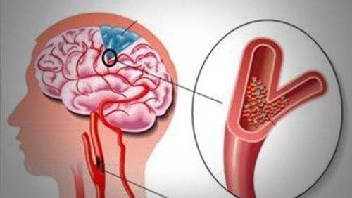 血管狭窄用药可以改善吗,老人血管狭窄吃什么药疏通