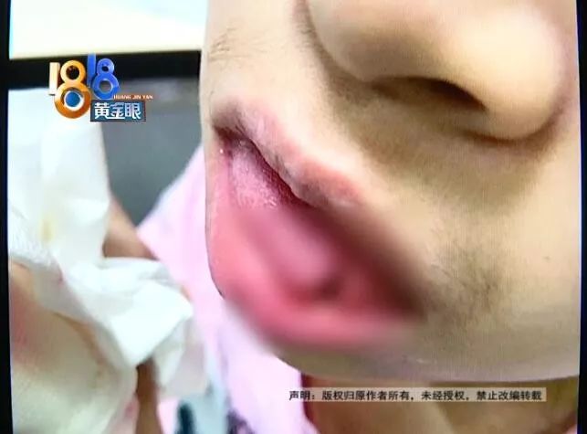 补牙把舌头下面划了一个洞,在小诊所补牙被扎舌头