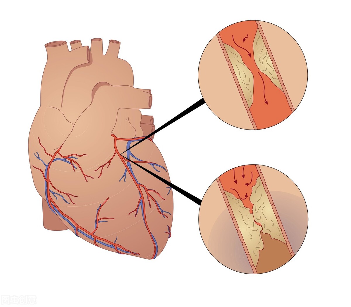 35岁突然心肌梗死什么原因,心肌梗死恢复期出现胸闷怎么办