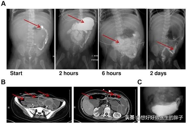 老人骨折卧床便秘怎么办,老年人骨折后老是恶心呕吐