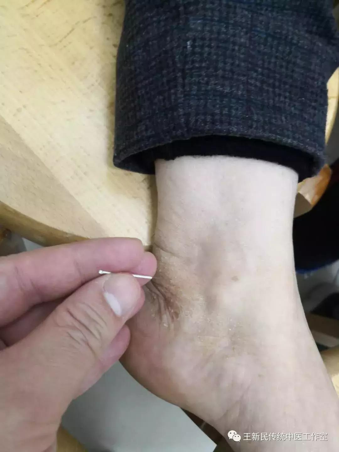 中医院王新民医术,王新民省中医院