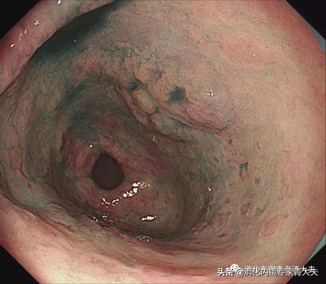 关于胃原位癌的科普文章,消化道早癌科普文章