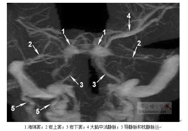 学习|颅脑静脉解剖及引流
