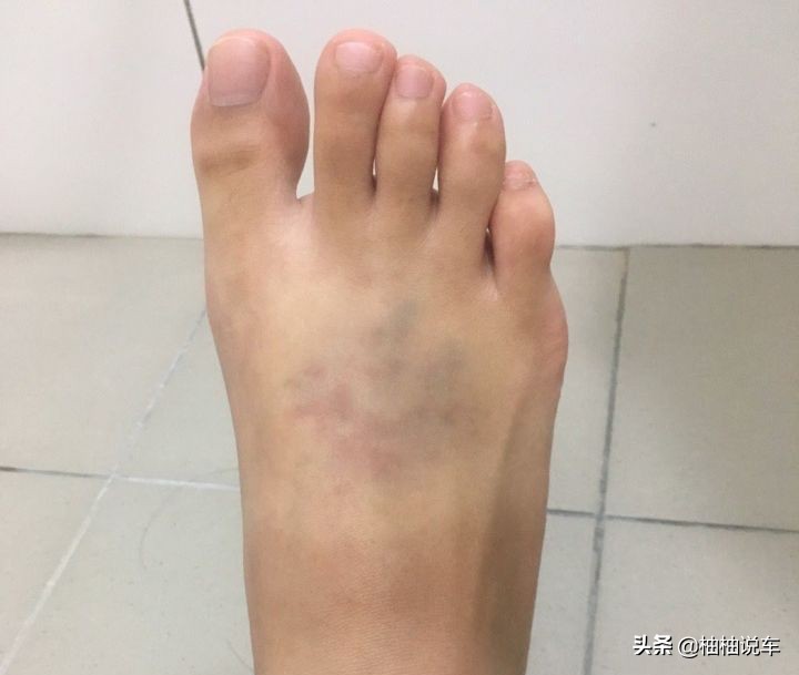 开车不小心压到人脚,车辆从脚上压过去没事