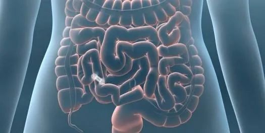 消化道胶囊内镜,消化道里的摄像头