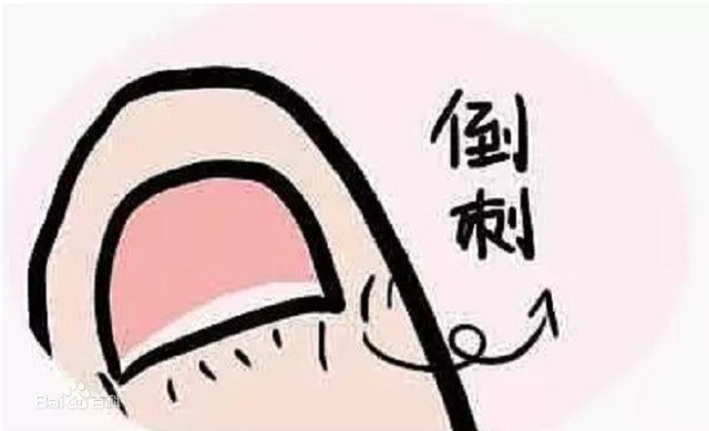 手上长倒刺是缺微量元素吗,手上长倒刺是缺爱吗