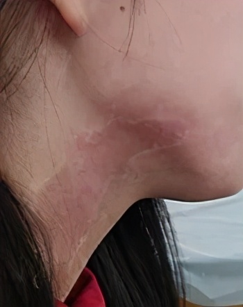 白癜风是个什么,白癜风到底是什么