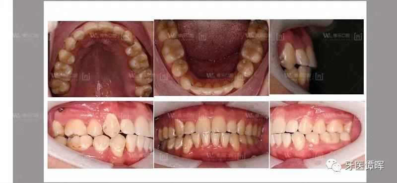 牙齿拥挤9个月变化图,牙齿拥挤排齐后嘴会凸吗
