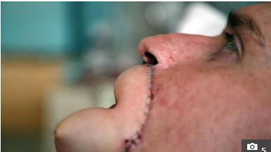 英国男子被狗咬了截肢,男子被动物咬脚趾截肢