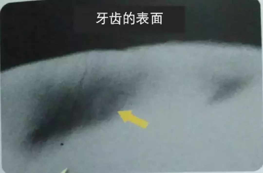 蛀牙下的牙龈有白色的小白点,牙齿有白斑是龋齿的前兆吗