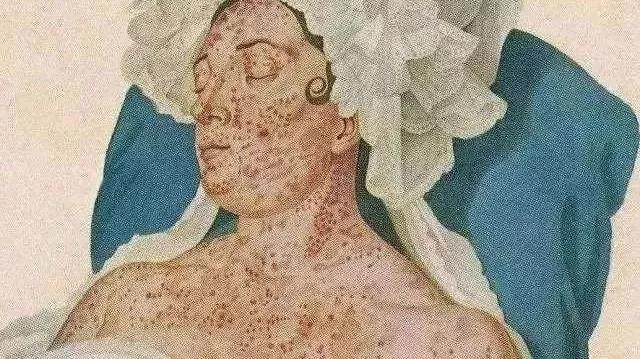 免疫治疗不良反应及处理方法,免疫治疗不良反应的处理