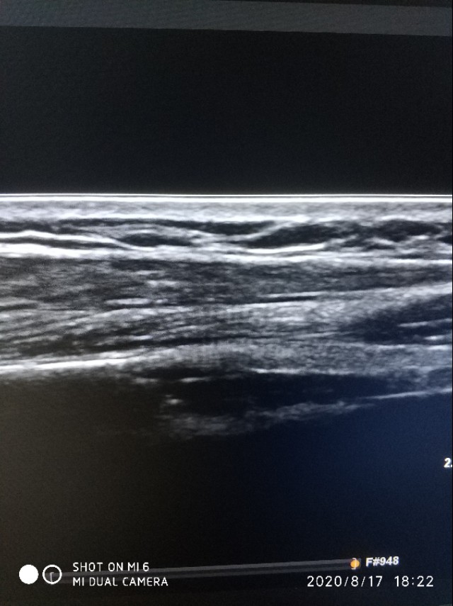 皮脂囊肿简介,皮脂囊肿和脂肪囊肿的区别