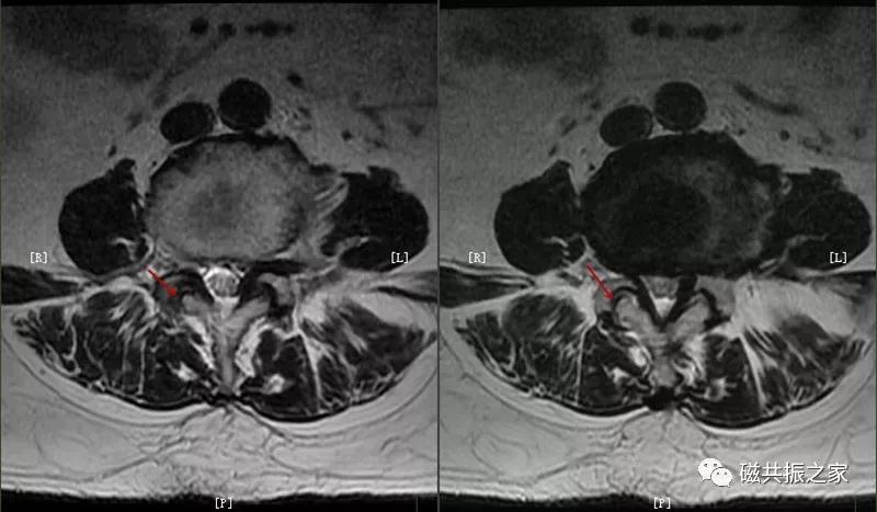 腰椎有哪些病变,腰椎病变有几种