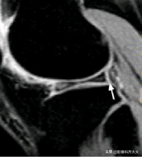 膝关节半月板损伤的磁共振,膝关节半月板病变的mri诊断与鉴别