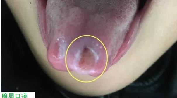 9岁孩子口腔溃疡怎么办,孩子反复口腔溃疡求良方