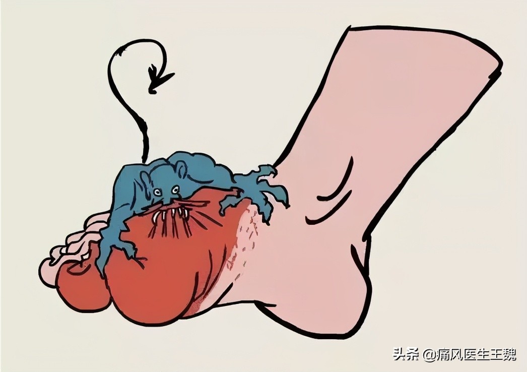 高尿酸血症及痛风年轻化,痛风做到这3点离好就不远了