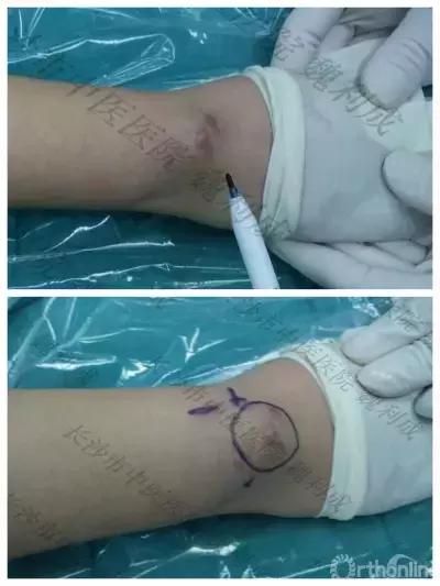 手腕囊肿抽吸出来后可否继续按压,足背囊肿穿刺好还是切除好