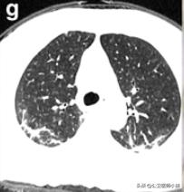 新型冠状病毒肺炎患者的肺,新型冠状病毒患者肺部体征