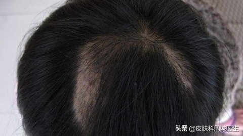斑秃一块又出现一块怎么办,一块一块的脱发是咋回事呀