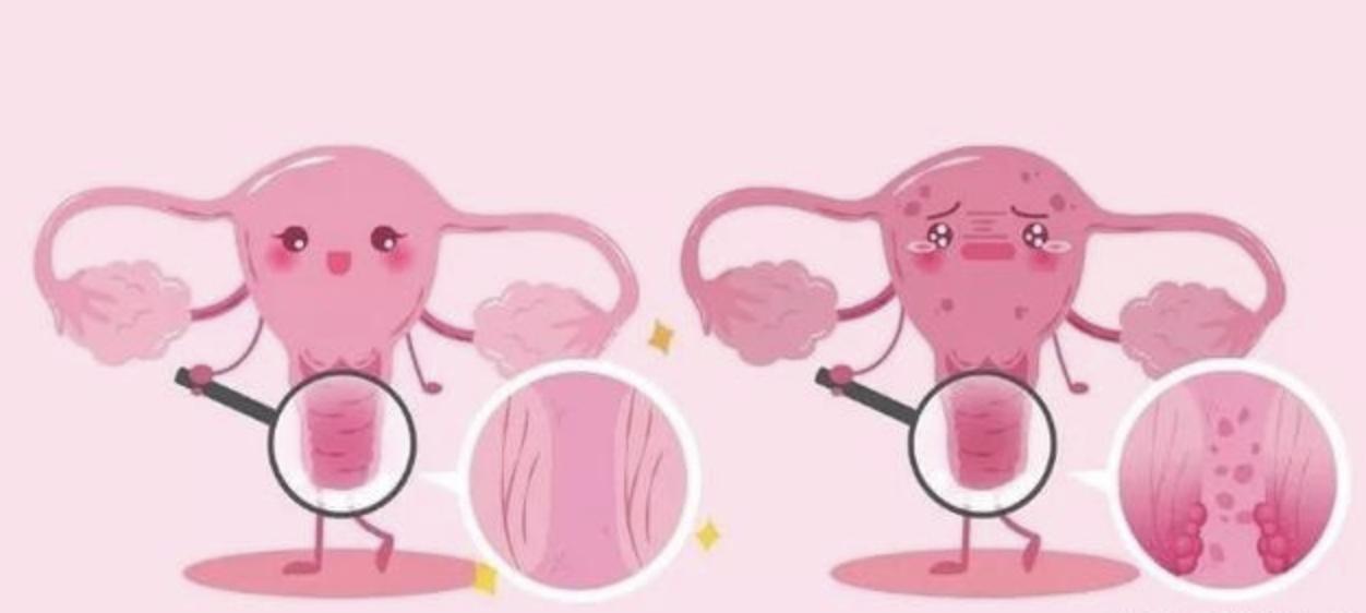 宫颈癌是目前唯一可以预防的癌症,宫颈癌是女性的第几大杀手