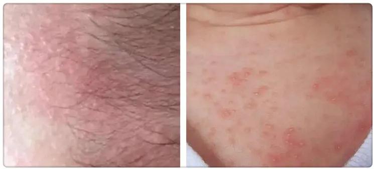 爽身粉去热痱子,长痱子用爽身粉可以去痱子吗