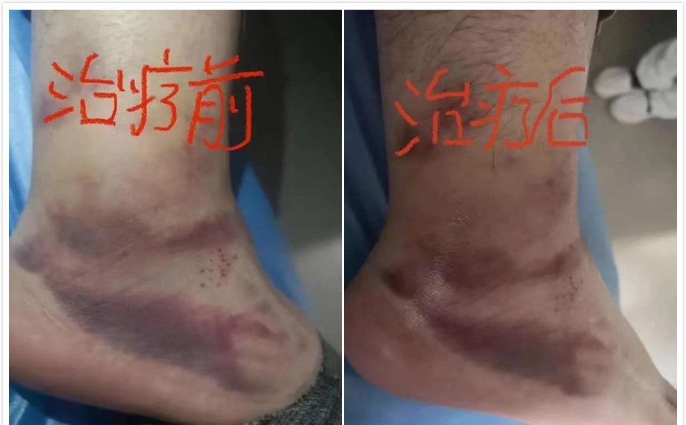 脚踝扭伤消肿散瘀针灸拔罐,脚扭伤消肿散瘀可以用拔火罐吗