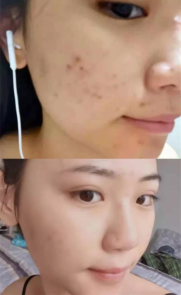 北京看痘痘好的皮肤科医院,去皮肤科看痘痘好不好