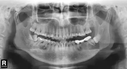牙医警示看牙第一步为什么要拍片,牙医看牙片可以看出什么