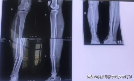 工人撞车在医院抢救视频,工人被车撞到骨折