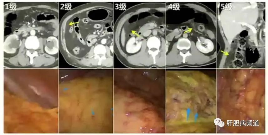 晚期胃癌转移卵巢怎么办,晚期胃癌转移肝有必要治疗么