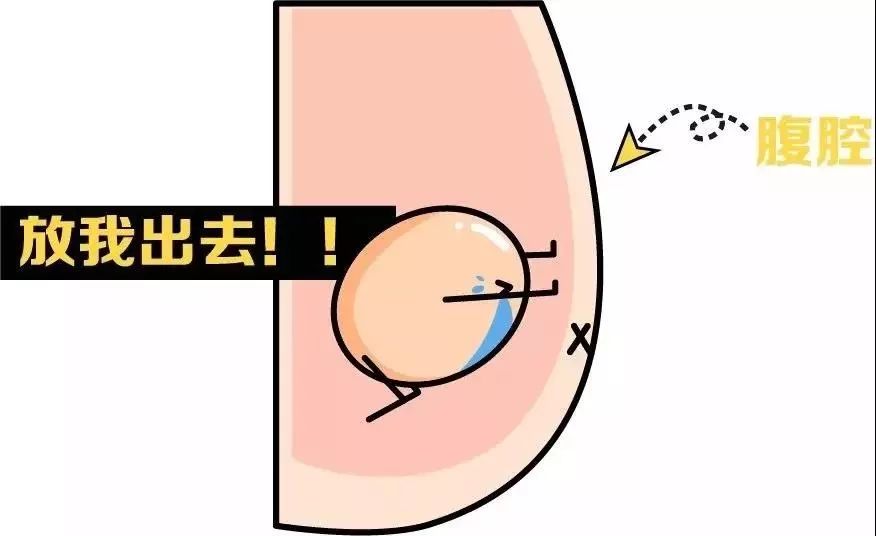 先天性隐睾就是没有蛋蛋吗,左边先天性隐睾的表现