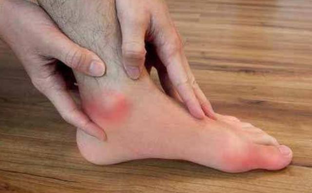 高尿酸五种不能吃,高尿酸是吃出来的少吃六种食物