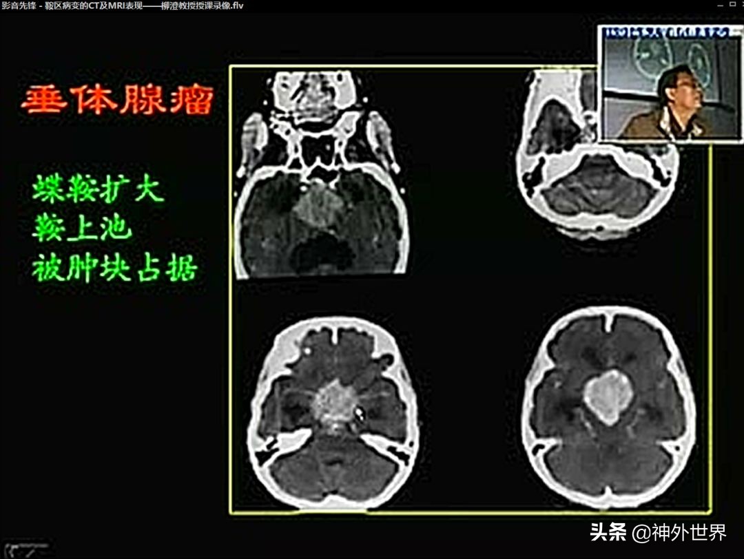鞍区核磁解剖图,鞍区解剖与手术