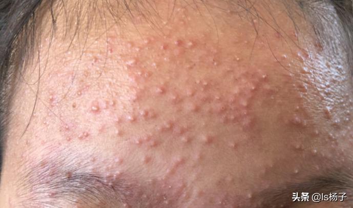脸上都是小米粒疙瘩冒白头且痒,红疙瘩有白尖里边有白色小米粒
