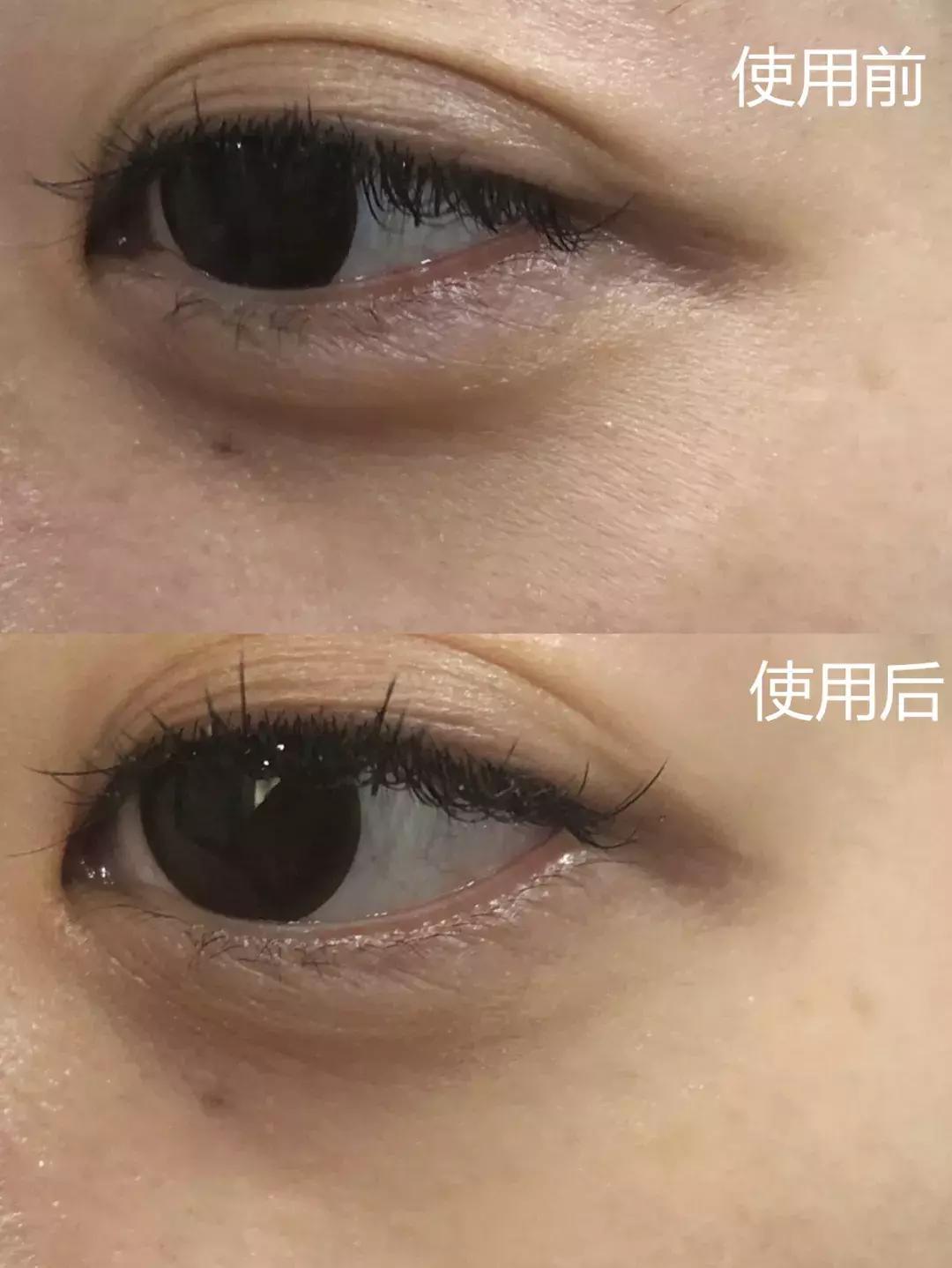 护肤黑科技顶级医美,用黑科技去除眼袋肿了十天