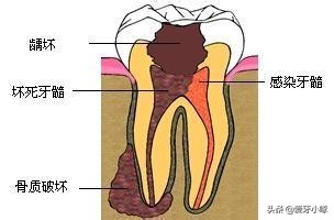 牙齿缺了一小块疼痛怎么办,牙齿缺了一块很疼怎么补救