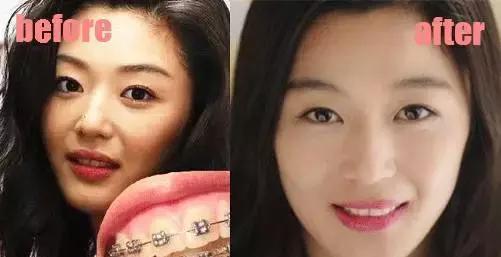 哪些明星整牙后像整容,明星整牙变美了