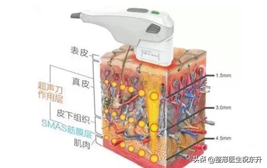 超声刀为什么一个月才能看到效果,超声刀真的会有效果吗