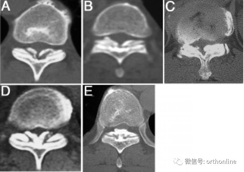 胸椎怎么做微创,脊柱内镜微创操作流程