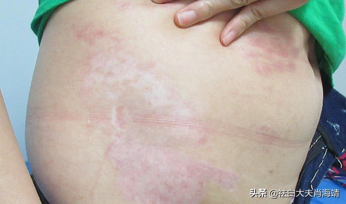 一根裤腰带，把21岁女生和白癜风绑在一起：这种习惯真的要不得