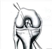 膝前叉韧带损伤严重还是变性严重,膝关节前叉韧带断裂膝盖会松动吗