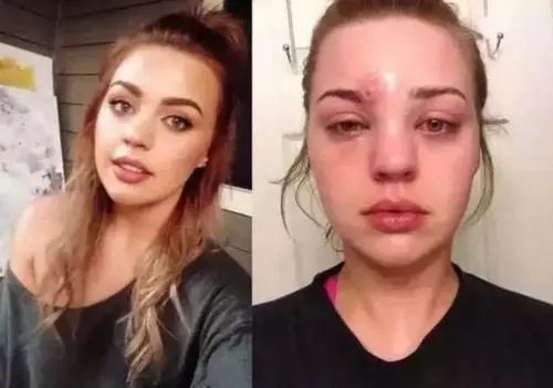 挤痘进了ICU，连下两次病危通知？这痘痘到底还能不能挤！