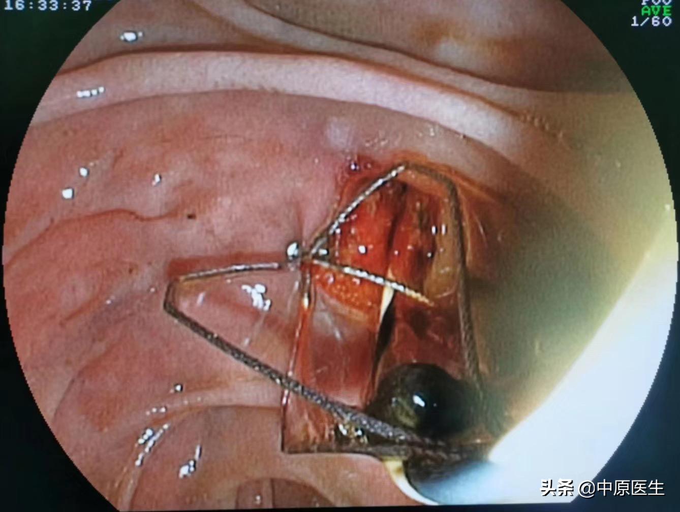 十二指肠与哪个器官对应,与十二指肠相邻的有哪些器官