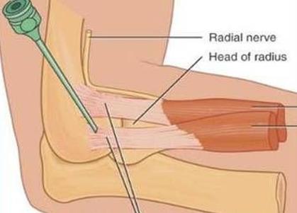 胳膊疼痛咋回事呀,胳膊疼痛咋回事