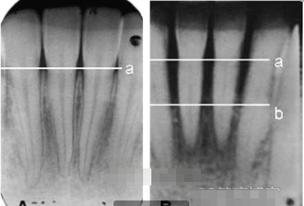 牙槽骨吸收牙根露出来怎么办,牙槽骨暴露会导致牙槽骨吸收吗