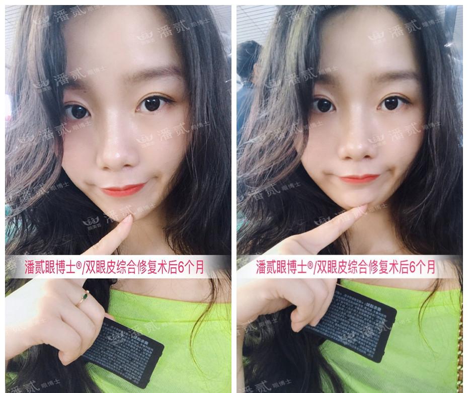 双眼皮整容失败眼皮跳动,双眼皮整形失败修复还花钱吗