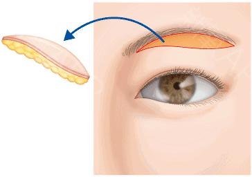 妈妈想做眉毛,妈妈急需做手术